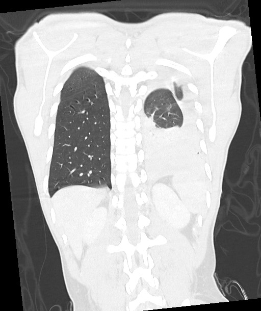 Arrow injury to the chest (Radiopaedia 85367-100975 Coronal lung window 103).jpg