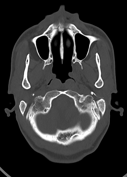 Arrow injury to the head (Radiopaedia 75266-86388 Axial bone window 43).jpg