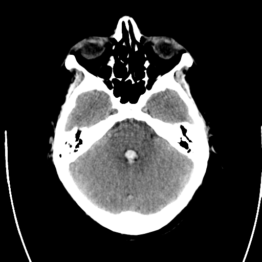 File:Arteriovenous malformation (cerebral) (Radiopaedia 40070-42579 Axial non-contrast 10).png
