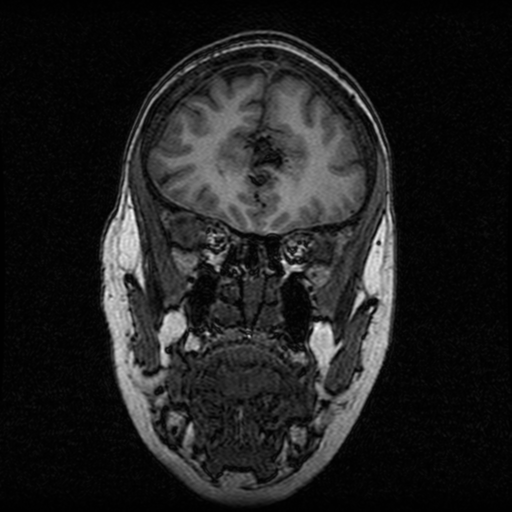 Arteriovenous malformation (cerebral) (Radiopaedia 40070-42580 Coronal T1 46).png