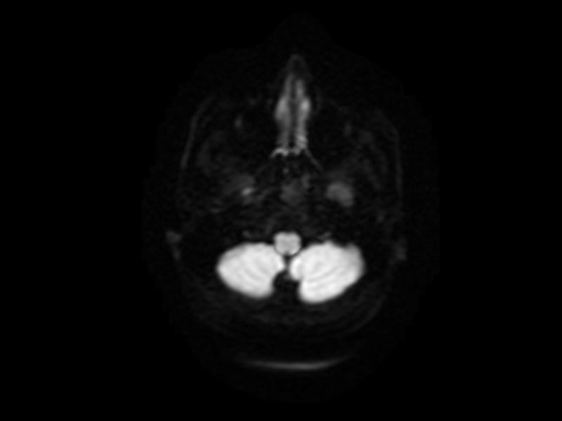 File:Artery of Percheron infarct (Radiopaedia 36897-38526 Axial DWI 1).jpg