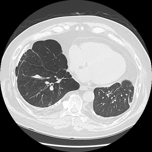 Asbestos-related pleural disease (Radiopaedia 74366-85250 Axial lung window 80).jpg