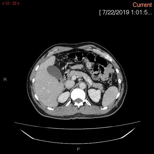 File:Ascending colonic diverticulum mimicking acute appendicitis (Radiopaedia 69943-80198 A 32).jpg