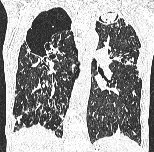 Aspergilloma- with Monod sign (Radiopaedia 44737-48532 Coronal lung window 293).jpg