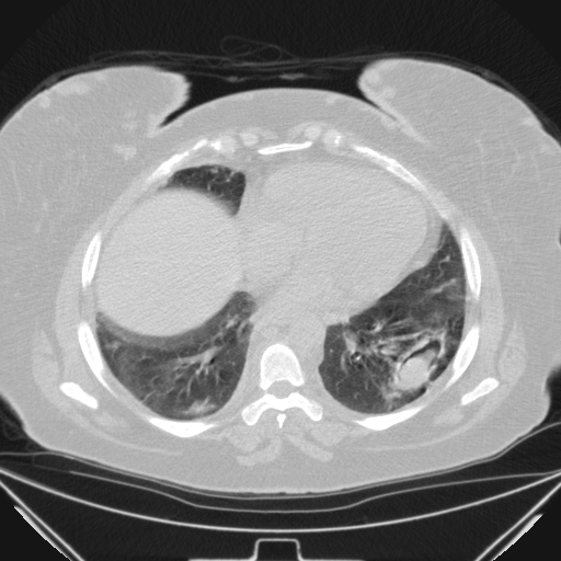 Aspergilloma (Radiopaedia 39611-41932 Axial lung window 89).jpg