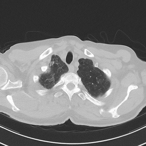 Aspergilloma on background pulmonary fibrosis (Radiopaedia 60942-68757 A 8).jpg