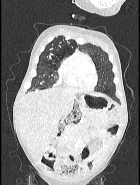 Asplenia syndrome (Radiopaedia 73083-83792 Coronal lung window 23).jpg