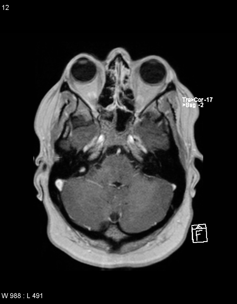 Astroblastoma (Radiopaedia 39792-42217 Axial T1 C+ 11).jpg