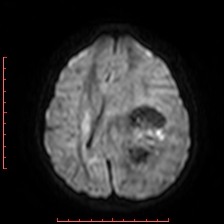 Astroblastoma (Radiopaedia 74287-85162 Axial DWI 63).jpg