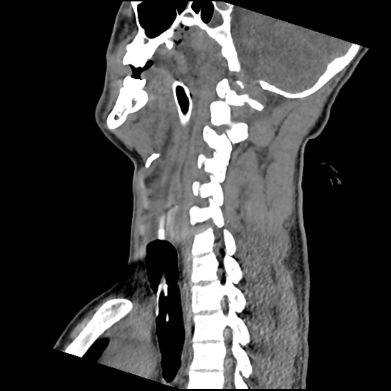 File:Atlanto-occipital dissociation (Traynelis type 1), C2 teardrop fracture, C6-7 facet joint dislocation (Radiopaedia 87655-104061 D 41).jpg