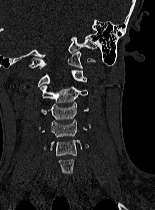 Atlantoaxial subluxation (Radiopaedia 44681-48450 Coronal bone window 53).jpg