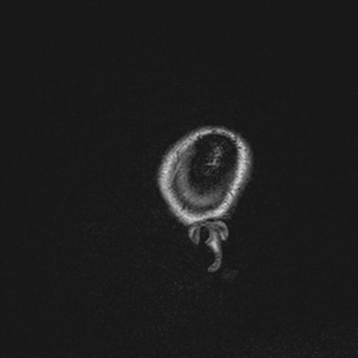 Atretic encephalocoele with inferior vermis hypoplasia (Radiopaedia 30443-31108 Sagittal FLAIR 14).jpg