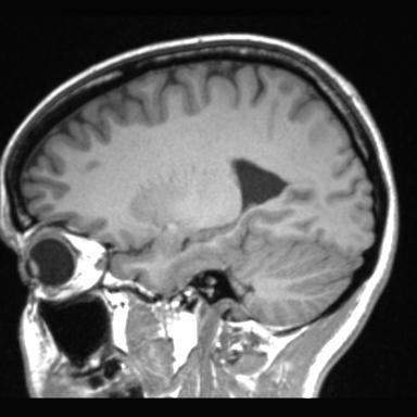 Atretic encephalocoele with inferior vermis hypoplasia (Radiopaedia 30443-31108 Sagittal T1 42).jpg