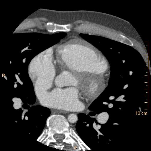 Atrial septal defect (upper sinus venosus type) with partial anomalous pulmonary venous return into superior vena cava (Radiopaedia 73228-83961 A 117).jpg