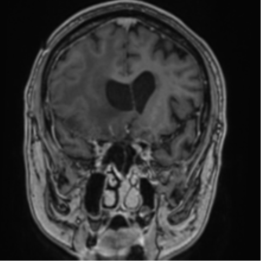 Atypical meningioma (WHO grade II) with brain invasion (Radiopaedia 57767-64729 Coronal T1 C+ 29).png
