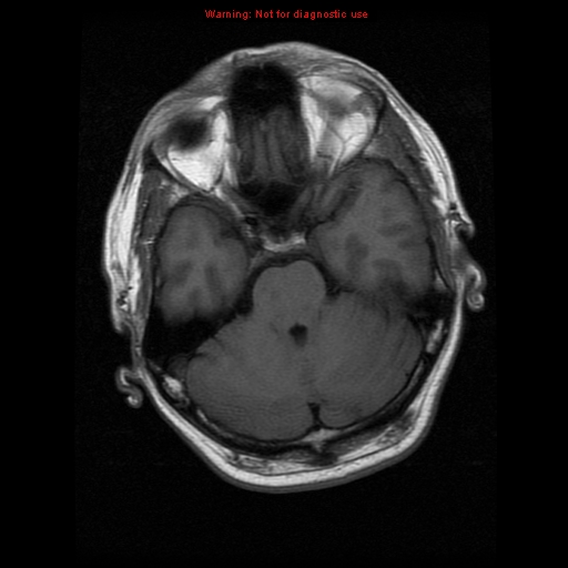 File:Atypical meningioma - grade II (Radiopaedia 13303-13305 Axial T1 7).jpg