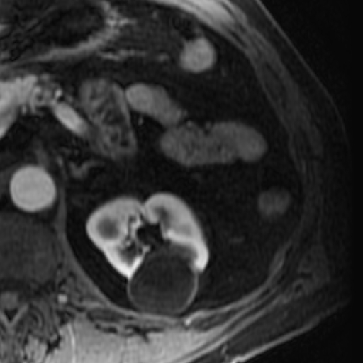 File:Atypical renal cyst on MRI (Radiopaedia 17349-17046 C 11).jpg