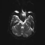 Autoimmune limbic encephalitis (Radiopaedia 30363-31005 Axial B0 and DWI 11).jpg