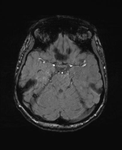 Autoimmune limbic encephalitis (Radiopaedia 30363-31005 SWI - magnitude 26).jpg