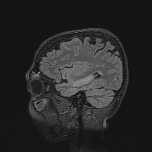 Autoimmune limbic encephalitis (Radiopaedia 30363-31005 Sagittal FLAIR 113).jpg