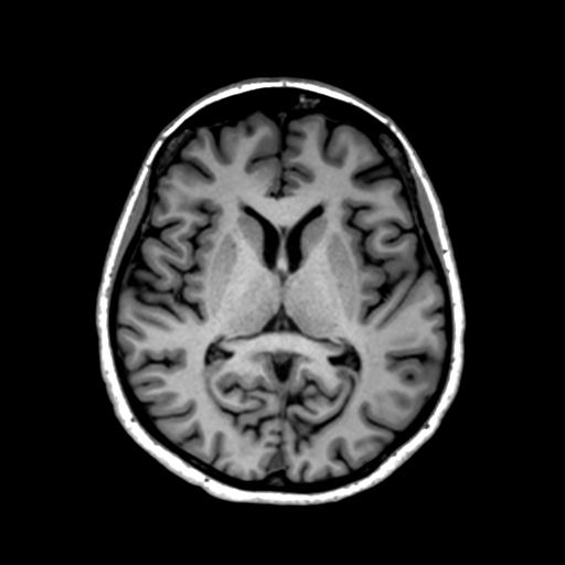 Autoimmune limbic encephalitis (Radiopaedia 30363-31005 T1 Axial 1mm 82).jpg