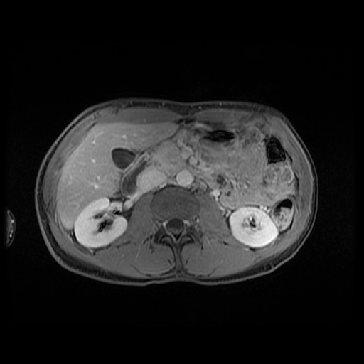 Autoimmune pancreatitis (Radiopaedia 69751-79729 N 77).jpg