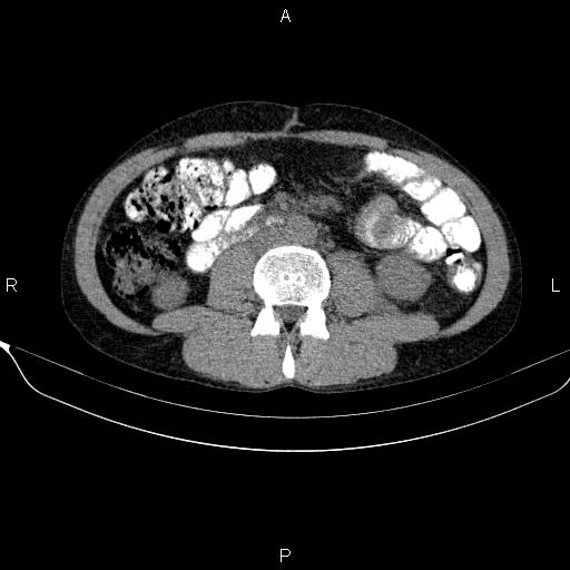 Autoimmune pancreatitis (Radiopaedia 84925-100431 Axial non-contrast 31).jpg