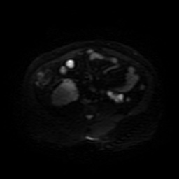 Autosomal dominant polycystic kidney disease (Radiopaedia 50259-55611 Axial DWI 33).jpg