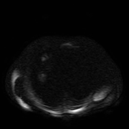 Autosomal dominant polycystic kidney disease (Radiopaedia 50259-55611 Axial DWI 73).jpg