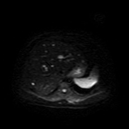 Autosomal dominant polycystic kidney disease (Radiopaedia 50259-55611 Axial DWI 9).jpg