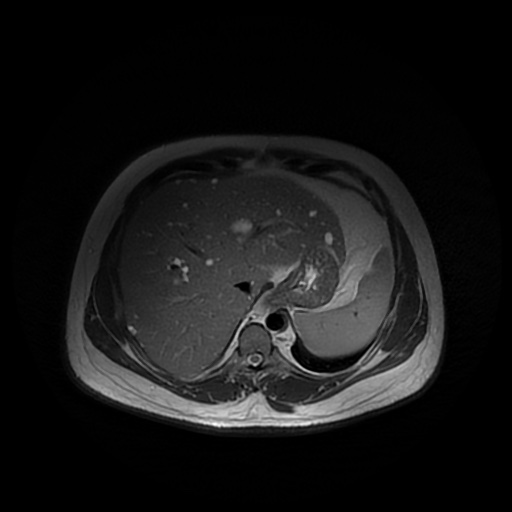 File:Autosomal dominant polycystic kidney disease (Radiopaedia 50259-55611 Axial T2 9).jpg
