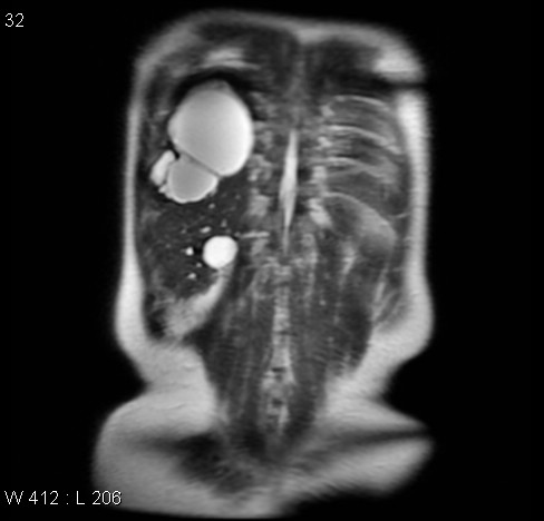 File:Autosomal dominant polycystic kidney disease (Radiopaedia 5202-6969 Coronal T2 13).jpg