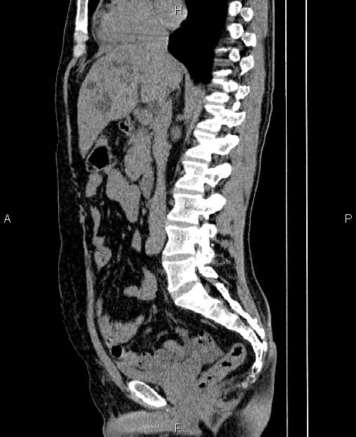 Autosomal dominant polycystic kidney disease (Radiopaedia 87830-104287 C 41).jpg