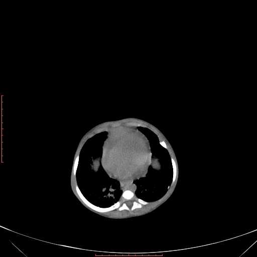 Autosomal recessive polycystic kidney disease associated with Caroli disease (Radiopaedia 61932-69984 B 92).jpg