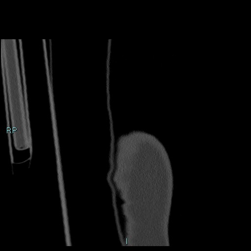 Avascular necrosis after fracture dislocations of the proximal humerus (Radiopaedia 88078-104655 Coronal bone window 7).jpg