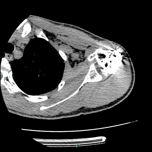 Avascular necrosis after fracture dislocations of the proximal humerus (Radiopaedia 88078-104655 D 52).jpg