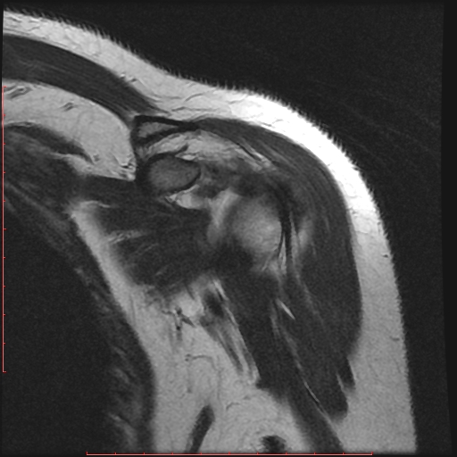 File:Avulsion fracture - greater tuberosity of humerus (Radiopaedia 25457-25703 Coronal T2 3).jpg