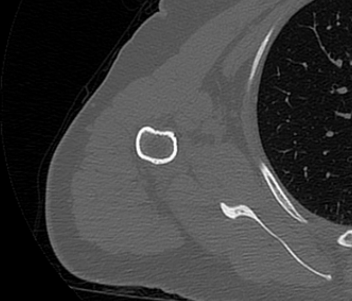 Avulsion fracture - greater tuberosity of humerus (Radiopaedia 71216-81514 Axial bone window 62).jpg