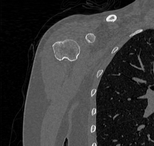 Avulsion fracture - greater tuberosity of humerus (Radiopaedia 71216-81514 Coronal bone window 9).jpg