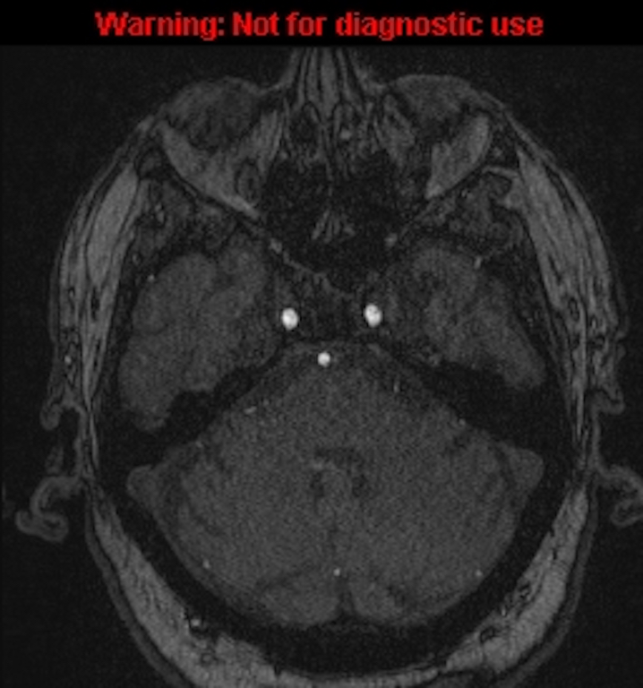 Azygos anterior cerebral artery (Radiopaedia 59325-66677 Axial MRA 40).jpg