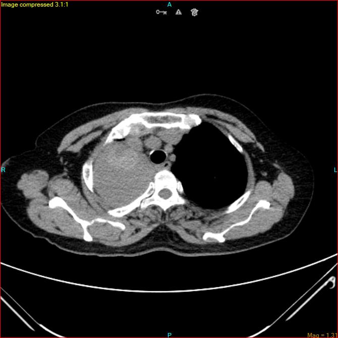 Azygos vein aneurysm (Radiopaedia 77824-90130 A 13).jpg