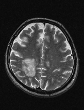 File:Balo concentric sclerosis (Radiopaedia 50458-55940 Axial T2 13).jpg