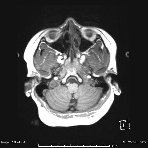 File:Balo concentric sclerosis (Radiopaedia 61637-69636 Axial T1 10).jpg