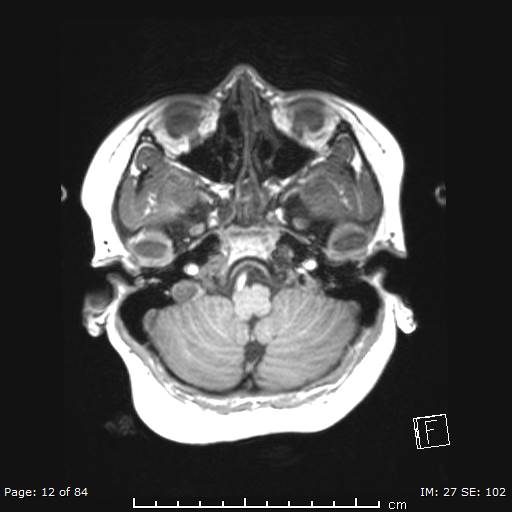 Balo concentric sclerosis (Radiopaedia 61637-69636 Axial T1 12).jpg