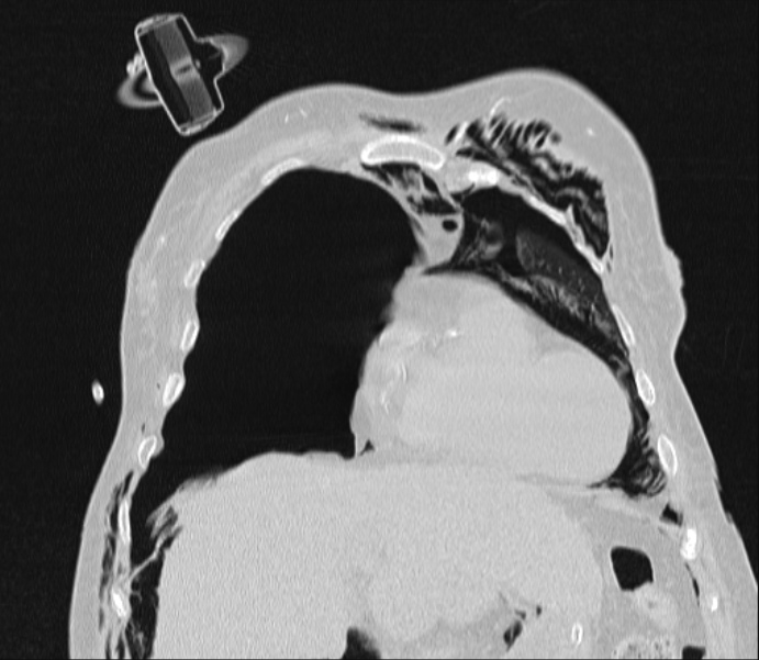Barotrauma due to mechanical ventilation (Radiopaedia 28079-28336 Coronal lung window 29).jpg