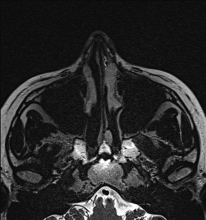 File:Basal cell carcinoma - nasal region (Radiopaedia 70292-80365 Axial Gradient Echo 21).jpg