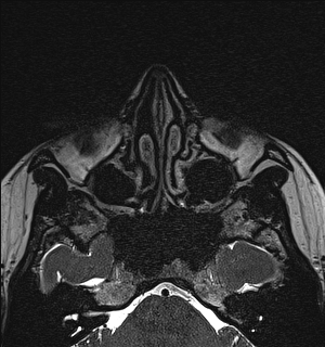 Basal cell carcinoma - nasal region (Radiopaedia 70292-80365 Axial Gradient Echo 46).jpg