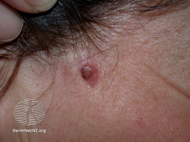 Basal cell carcinoma affecting the face (DermNet NZ lesions-bcc-face-1057).jpg