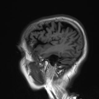 File:Base of skull chondrosarcoma (Radiopaedia 30410-31070 Sagittal T1 17).jpg
