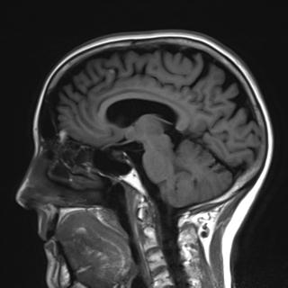 File:Base of skull chondrosarcoma (Radiopaedia 30410-31070 Sagittal T1 9).jpg
